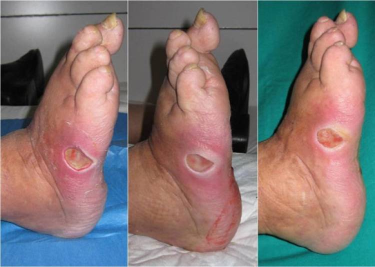 पैरों की समय पर जांच बचा सकती है डायबेटिक फुट की गंभीर समस्‍या से
