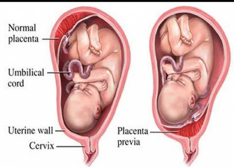 यहां पाएं गर्भावस्था के आख़िरी दिनों में रक्तस्राव के बारे में हर जानकारी