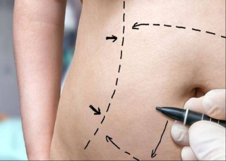 वर्ल्‍ड ओबेसिटी डे: मोटापा घटाने वाली बेरियेट्रिक सर्जरी के बारे में जानें सबकुछ