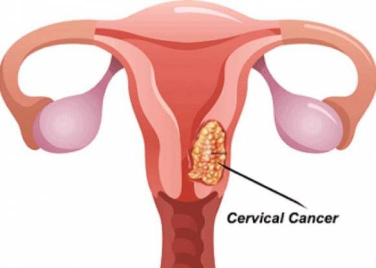 महिलाओं के लिये जानलेवा है सर्वाइकल कैंसर, जानें इससे बचने के आसान तरीके