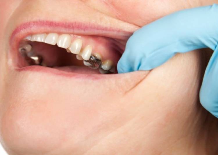 दांतों की फिलिंग जरूरी क्यों है, कब करानी चाहिए, क्या सावधानी रखें? जानें जवाब