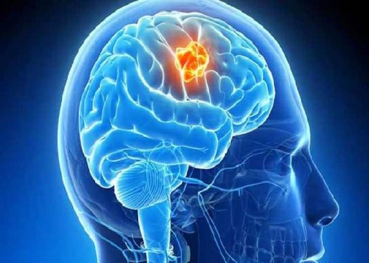 World Brain Tumor Day: ब्रेन ट्यूमर है जानलेवा, ऐसे पहचानें, समय रहते डॉक्टर से लें सलाह