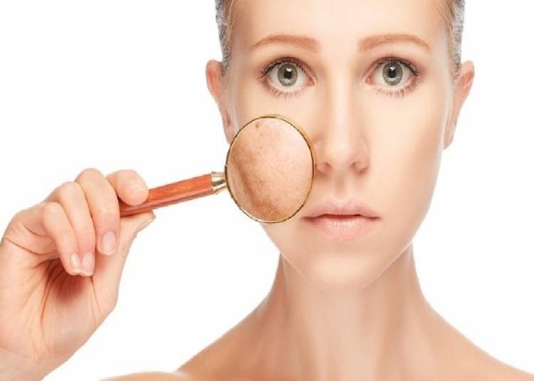 कील-मुहासों से चेहरे पर पड़ने वाले निशान को हटाने और बेदाग त्वचा के लिए अपनाएं ये उपाय 