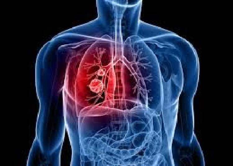 World Lung Cancer Day 2020: ये 4 तरीके घटा सकते हैं फेफड़ों के कैंसर खतरा