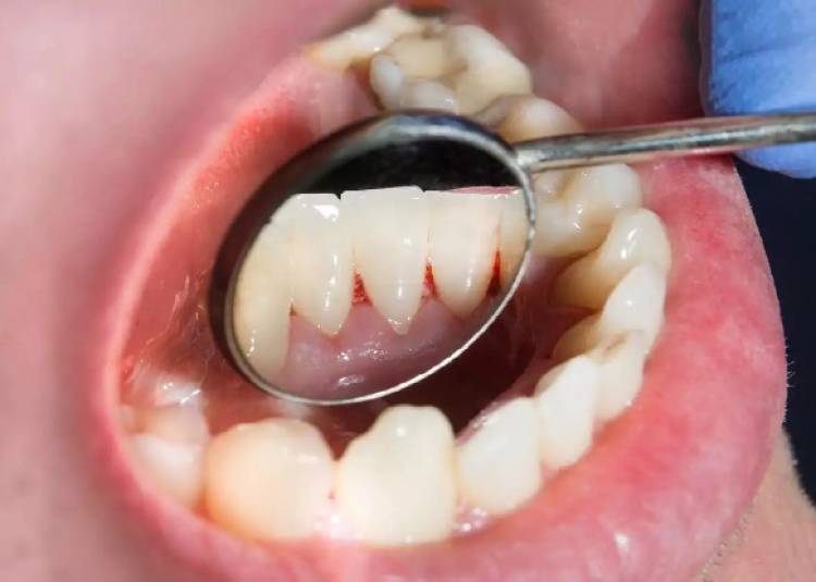 जानिए, दांतों में कीड़े लगने की सही वजह और कुछ कारगर घरेलू इलाज?